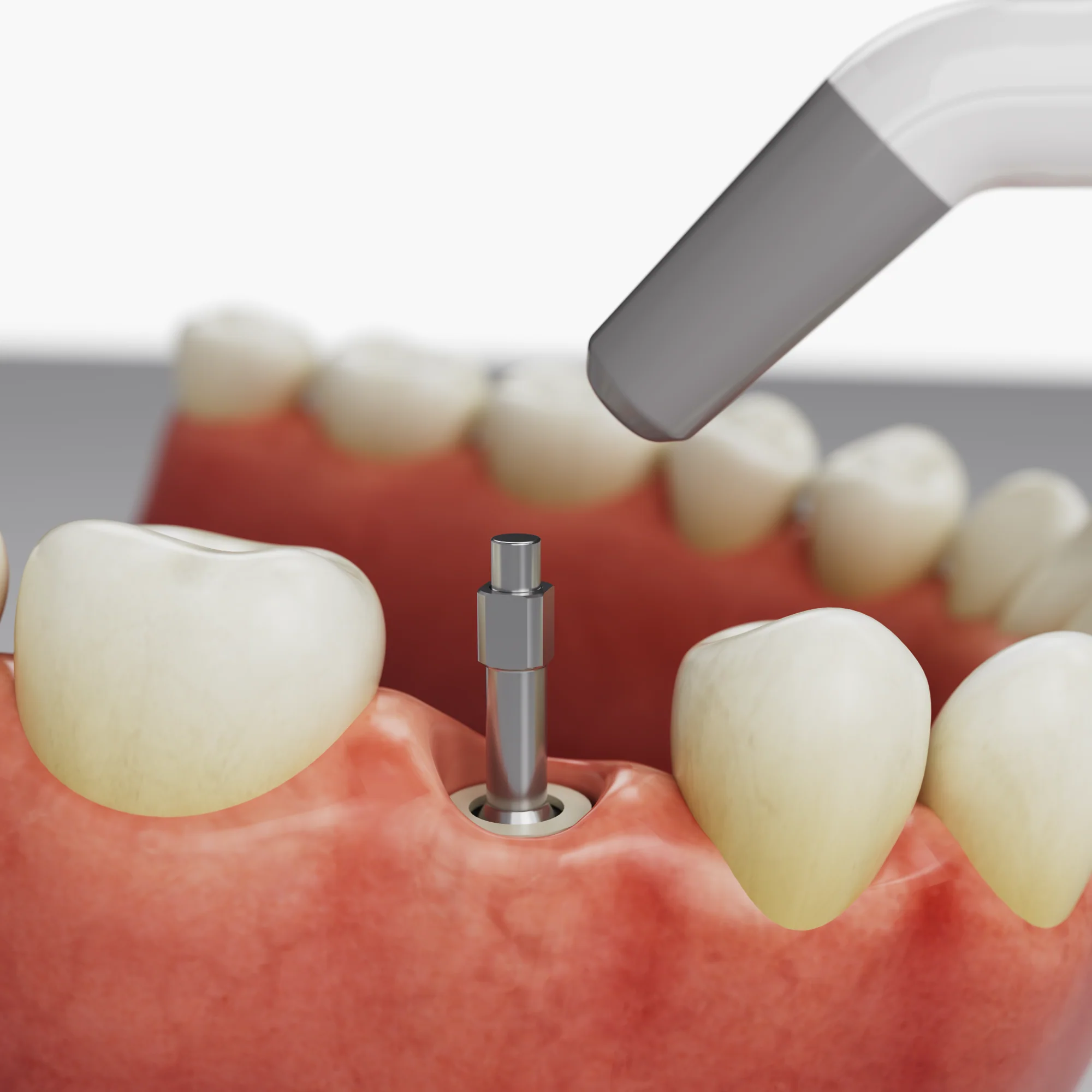 ChecQ ISQ - Quick Check for Implant Stability - Image 9