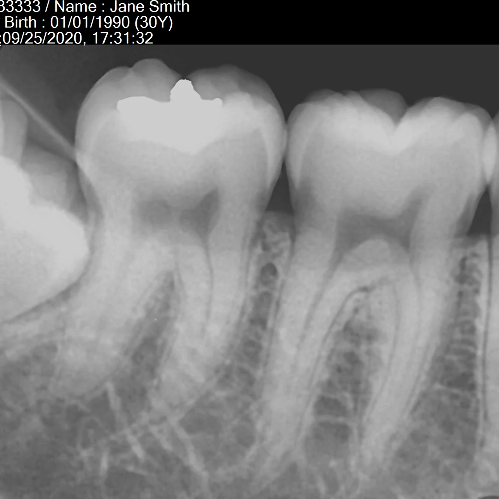 Digital Intraoral Image Sensor - CALL FOR PRICE - Image 4